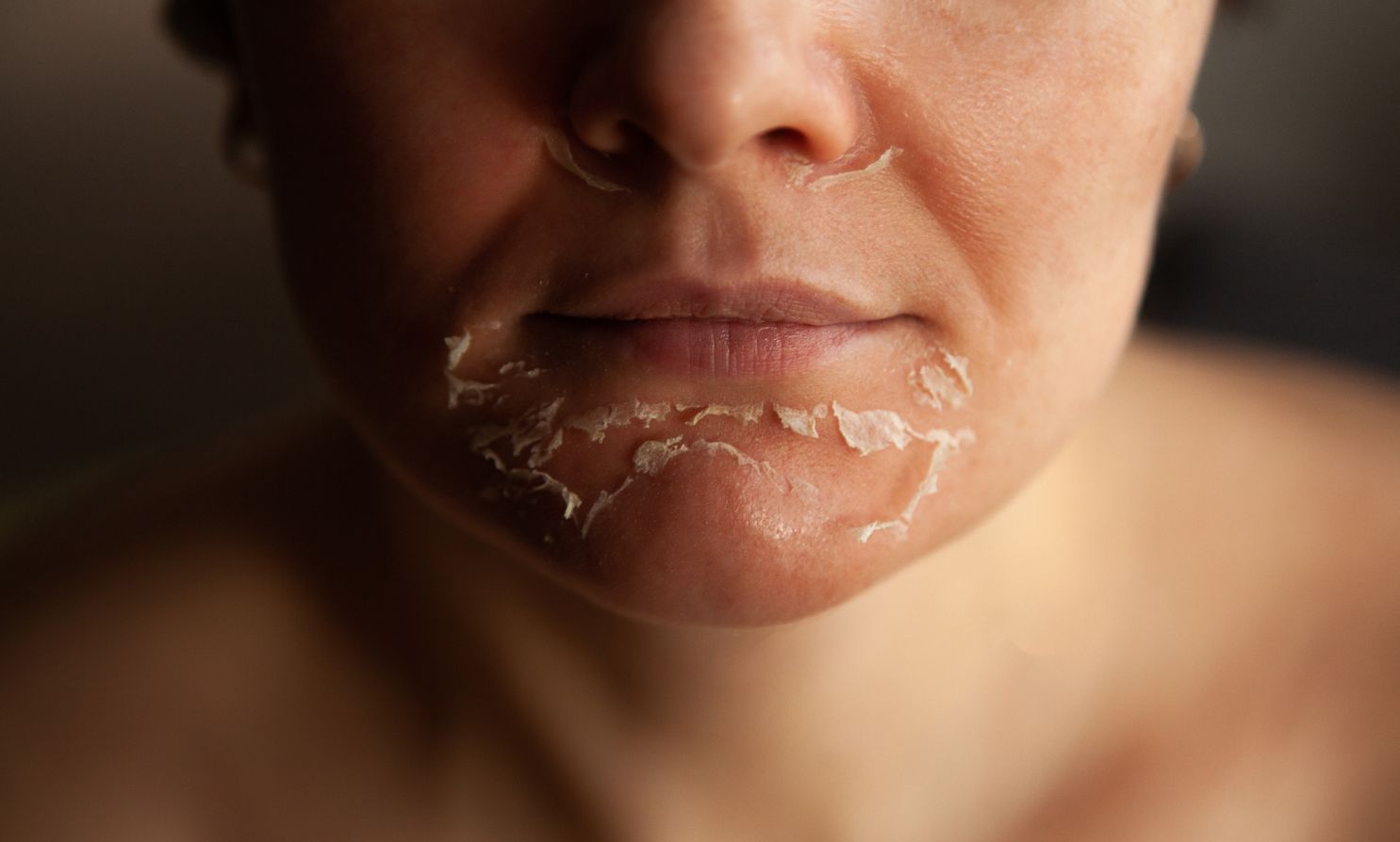 Is a TCA Peel Safe for Mature Skin?
